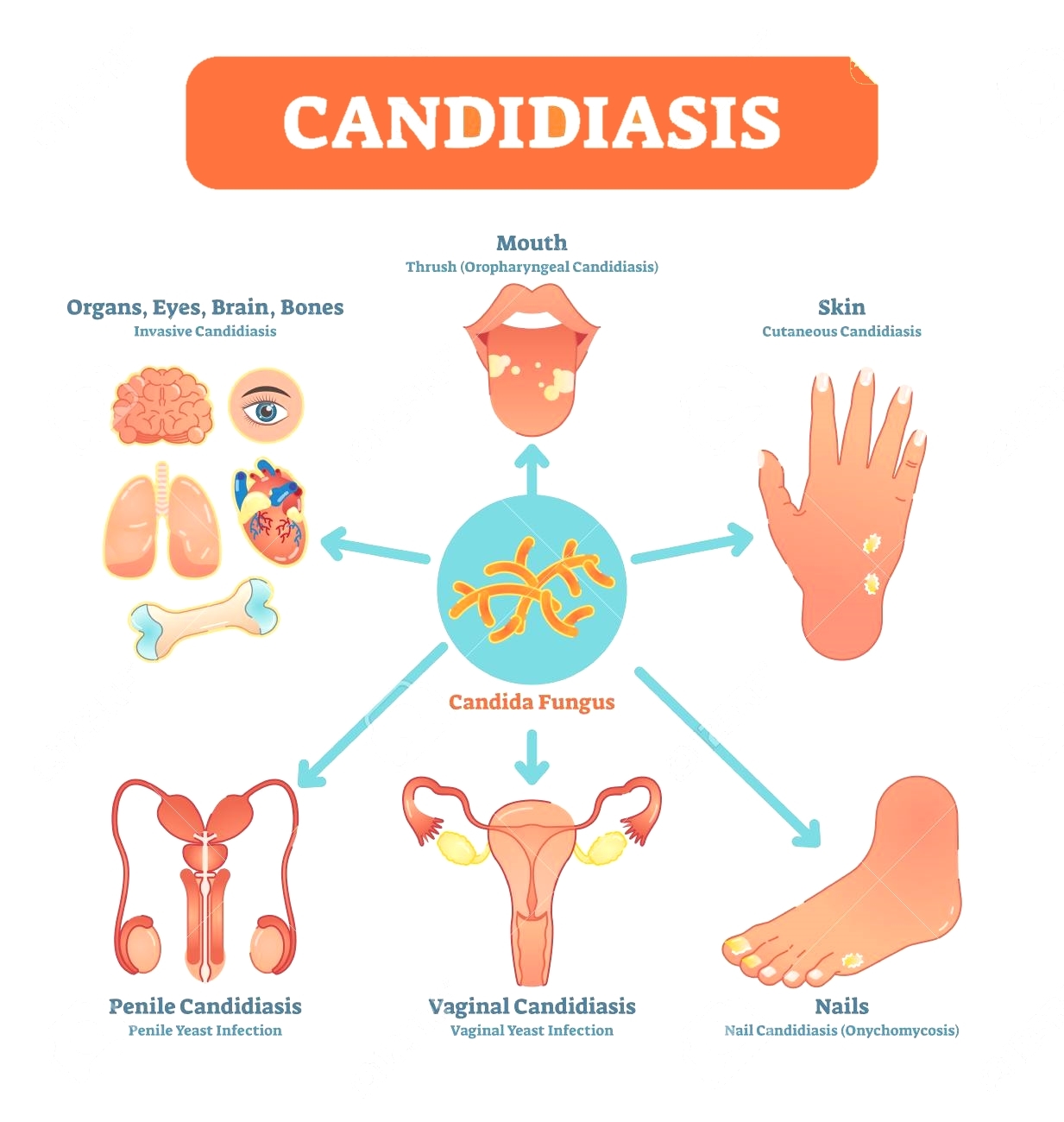 Candida treatment on sale